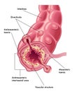 Diverticula