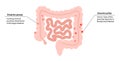 Diverticulitis and diverticulosis