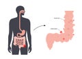 Diverticulitis and diverticulosis