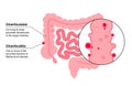 Diverticulitis and diverticulosis