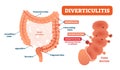 Diverticulitis vector illustration. Labeled diagram with its structure Royalty Free Stock Photo