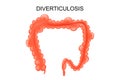 Diverticulosis of the colon Royalty Free Stock Photo