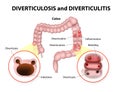 Diverticulosis and Diverticulitis Royalty Free Stock Photo