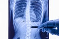 Doctor analyzing X ray of the spine showing scoliosis in the lumbar area Royalty Free Stock Photo