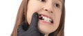 A doctor in black medical gloves examines the oral cavity of a little cute girl. Crooked teeth. Studio photo on a white background