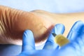 The doctor checks the patient`s leg in blue gloves. Holds a syringe for pointing. The heel is swollen and cracking. close-up