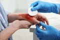 Doctor covering patient`s burn of hand with cotton pad indoors, closeup