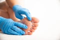 A doctor covers calluses on a person s foot with a special plaster. Copy space for text, papilloma