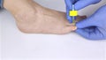 The doctor dermatologist drops the medicine with a pipette on the nail affected by the fungus. Antimycotic therapy. Treatment of c