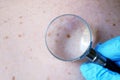 Doctor dermatologist examines birthmark of patient. Checking benign moles Royalty Free Stock Photo