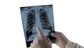 Doctor diagnoses pneumonia, x-ray of man`s lungs isolated on white background, picture of human lungs.