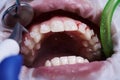 Doctor doing professional teeth cleaning in dental clinic