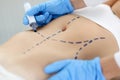 Doctor drawing preoperative marking on patient abdomen closeup Royalty Free Stock Photo