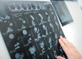 Doctor examines the CT picture on negatoscope Royalty Free Stock Photo