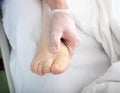 Doctor examines foot with edema Royalty Free Stock Photo