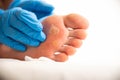 A doctor examines the foot of a person who has a large callus and a stem wart. Treatment and removal of warts and corns Royalty Free Stock Photo