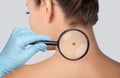 The doctor examines a large mole on the shoulder with a magnifying glass in the clinic. Cosmetology treatment of problem skin on