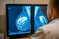 Doctor examines mammogram snapshot of breast of female patient on the monitors. Selective focus. Royalty Free Stock Photo