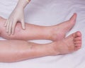 Doctor examines the patient`s legs for the presence and degree of varicose veins in the legs, close-up, white background Royalty Free Stock Photo