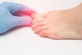 Doctor examines a sore toe infected with fungal infection, close-up, onychomycosis, medical Royalty Free Stock Photo