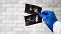 The doctor examines the ultrasound images of the prostate gland close-up, photographs of the prostate in the hands of a medical