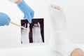 Doctor examines x-ray image, broken leg of the patient in plaster lying on the couch