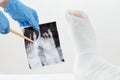 Doctor examines x-ray image, broken leg of the patient in plaster lying on the couch