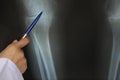 Doctor hand holding a pen on chest x-ray film of knee joint, Medicine concept Royalty Free Stock Photo