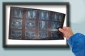 A doctor holding and analyzes spine radiography X-ray