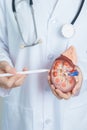 Doctor holding Anatomical kidney Adrenal gland model. disease of Urinary system and Stones, Cancer, world kidney day, Chronic