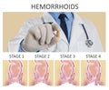 Doctor holding suppository for hemorrhoid treatment over illustration of lower rectum progressing disease