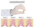 Doctor holding suppository for hemorrhoid treatment over illustration of lower rectum progressing disease