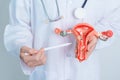 Doctor holding Uterus and Ovaries model. Ovarian and Cervical cancer, Cervix disorder, Endometriosis, Hysterectomy, Uterine