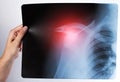 The doctor holds in his hand an x-ray of a dislocated shoulder joint and a fracture of the humerus. Inflammation and