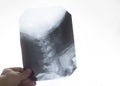The doctor holds in his hand an x-ray picture of the cervical spine of the patient. The concept of neck diseases Royalty Free Stock Photo
