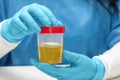 doctor or laboratory technician holds a plastic container with a urine sample for analysis
