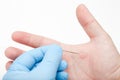 Doctor lancing a blister on a man's palm Royalty Free Stock Photo