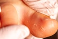 Doctor little girl`s foot with fungus infection Royalty Free Stock Photo