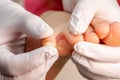 Doctor little girl`s foot with fungus infection Royalty Free Stock Photo