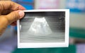 Doctor looking at blurry obstetric ultrasound paper report in antenatal clinic in the hospital.