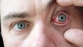 Doctor Looks at Male Patient with Red Inflamed Eyes with Conjunctivitis