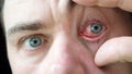 Doctor Looks at Male Patient with Red Inflamed Eyes with Conjunctivitis