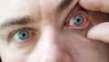 Doctor Looks at Male Patient with Red Inflamed Eyes with Conjunctivitis