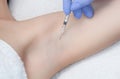 The doctor makes intramuscular injections of botulinum toxin in the underarm area