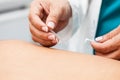 Doctor performing acupuncture on a male patient