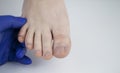 Doctor podologist examines the fungus of the nail on the womanÃ¢â¬â¢s foot. Treatment of onychomycosis, mycosis. Deformed nail plate