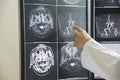 Doctor pointing to brain anatomy on MRI image Royalty Free Stock Photo