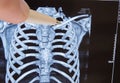 Doctor points out pen on clavicle in picture of 3D computer tomography. Anatomical location of collarbone and frequent destination Royalty Free Stock Photo