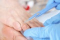 Doctor removes callus with scalpel. Podiatry medical services