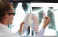 Doctor with ribs and lungs model pointing at x-ray image